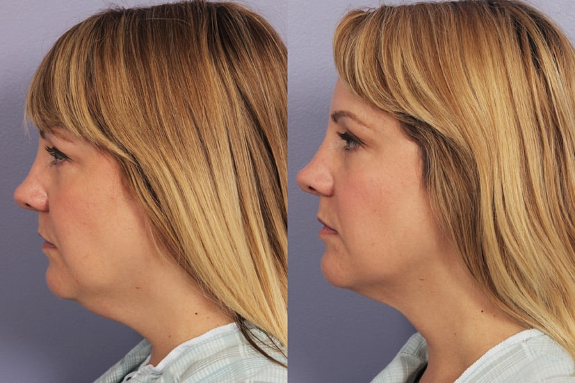 profile view of a blonde woman showing before and after results of coolsculpting