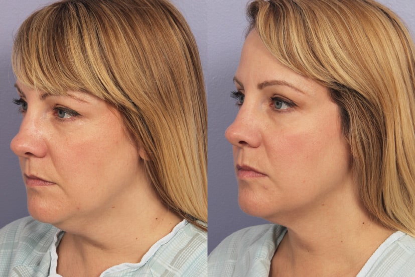 Before and after image of a woman that received cool sculpting treatment
