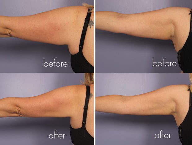 Before and after collage of a woman's arms after receiving cool sculpting treatment