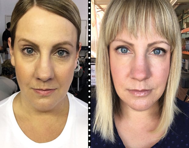 restylane-injectable-results-before-after-photos