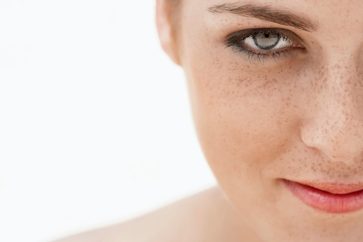 How to Remove Freckle Spots the Natural Way