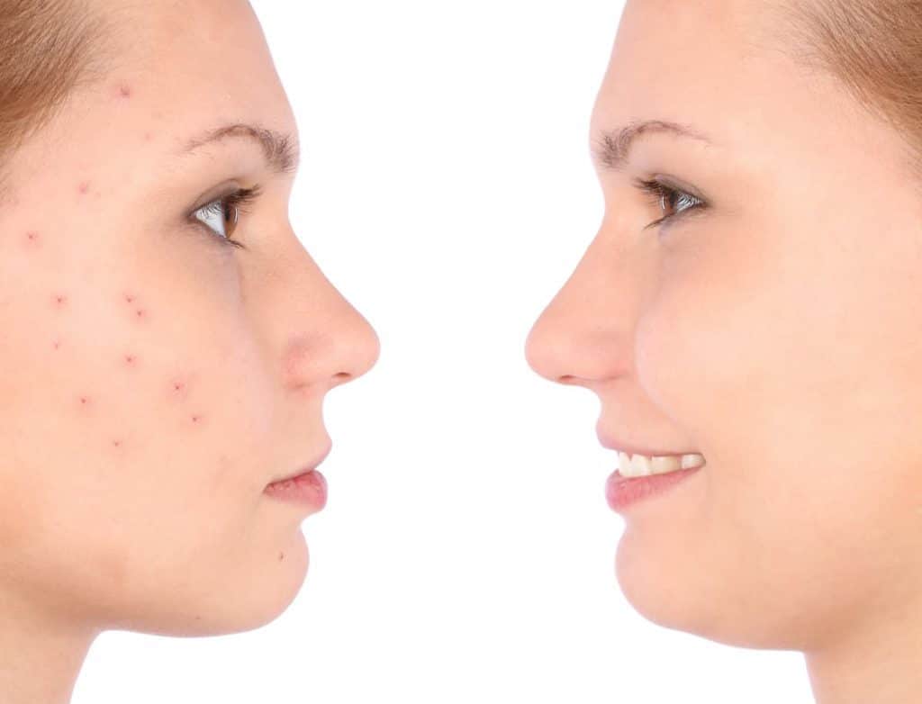clear skin concept with portrait of a young girl with acne and with healthy clear skin