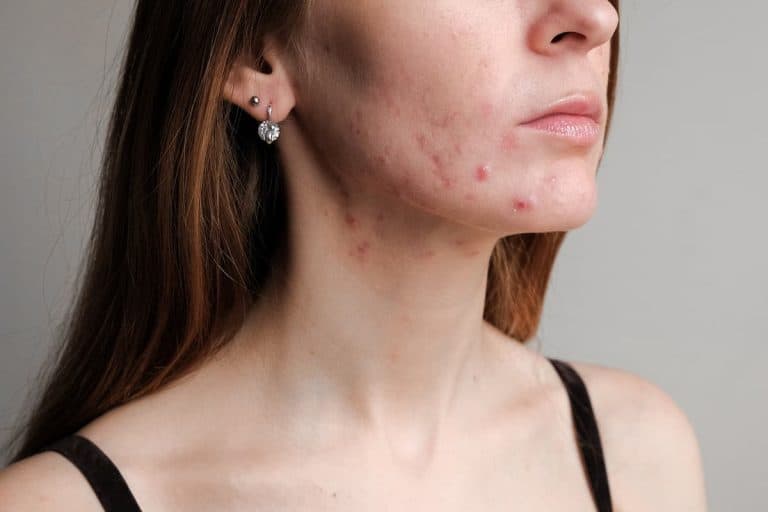 Fungal Acne Vs Closed Comedones: Are They Different?