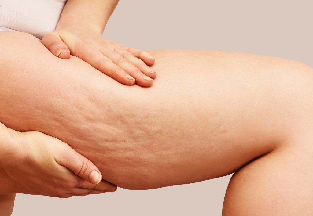 a close-up image of a woman's thigh with cellulite