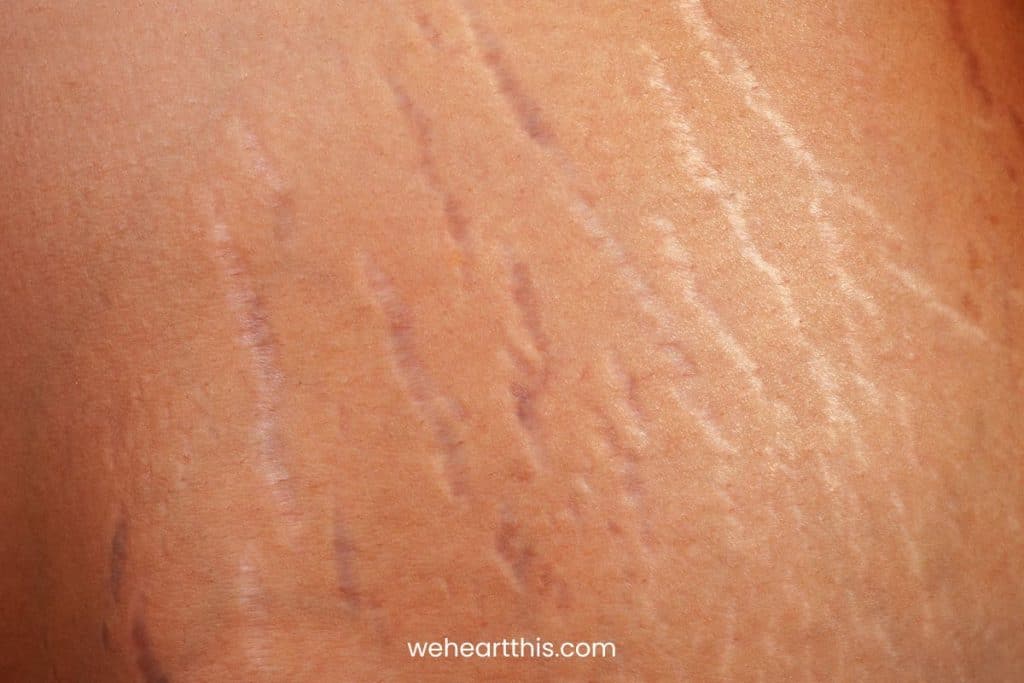 Closeup of stretch marks on the body