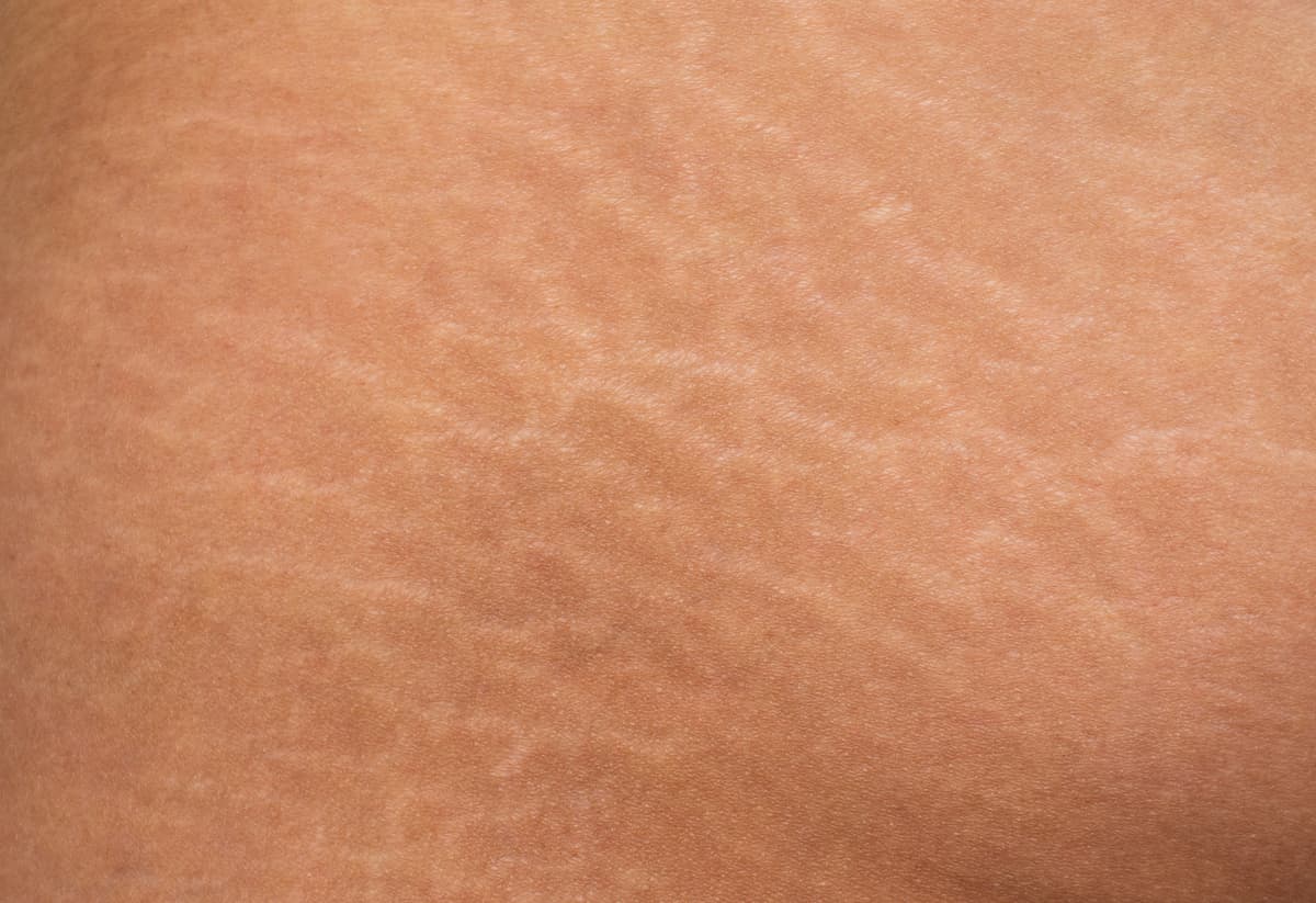 Microneedling for Stretch Marks: Benefits, Risks, and More
