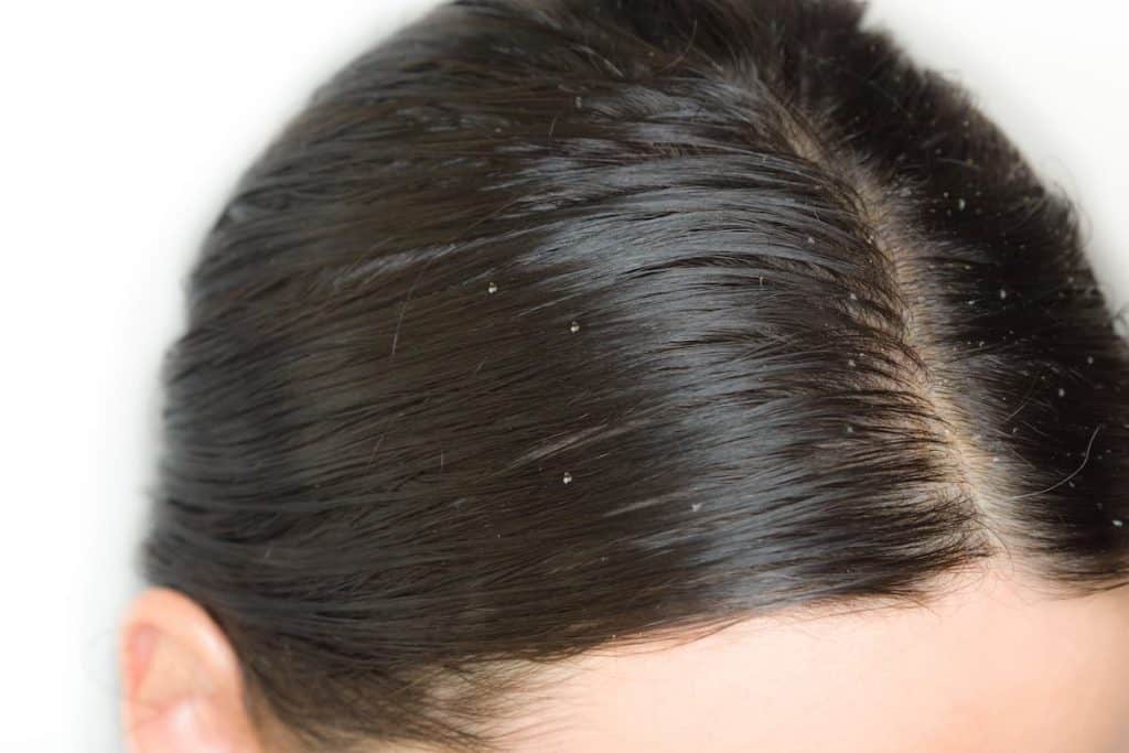 A close up of a woman's oily hair with small flakes