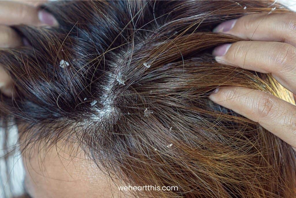 Closeup of a woman's hair scratching her hair that has a dandruff on her scalp and hair  