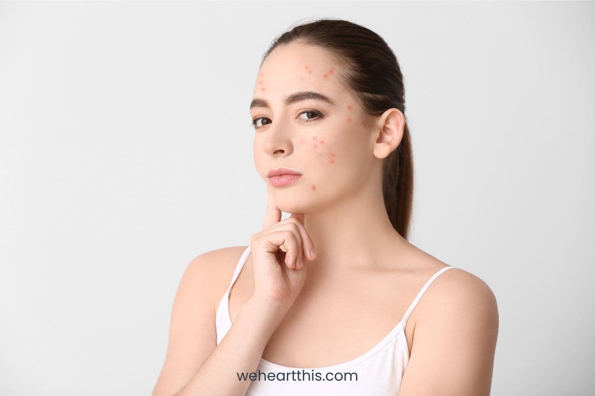 Best Probiotics for Acne + the Science Behind Gut and Skin Health