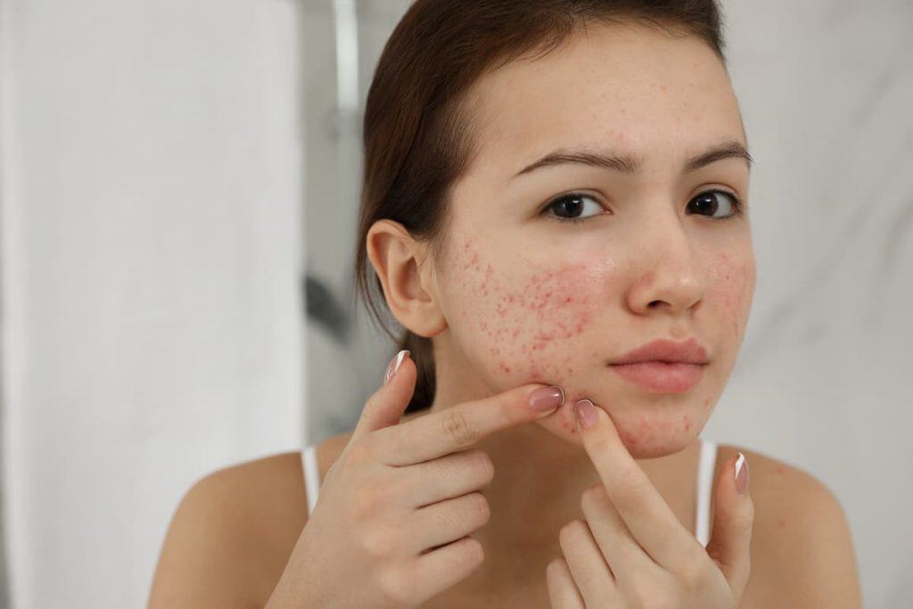 A teen girl with acne squeezing her pimple