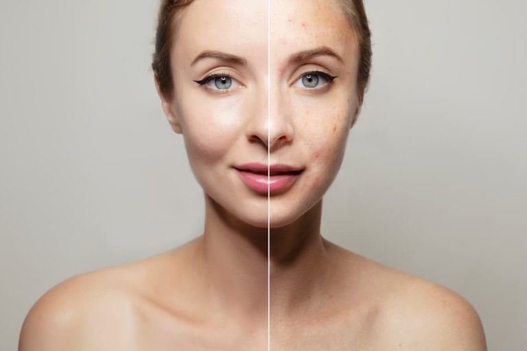Azelaic Acid vs Salicylic Acid: Which Is The Real Acne Champion