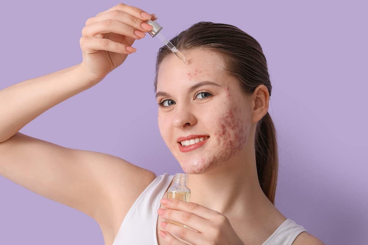 Niacinamide vs. Salicylic Acid Which One Is Top for Skin Care?