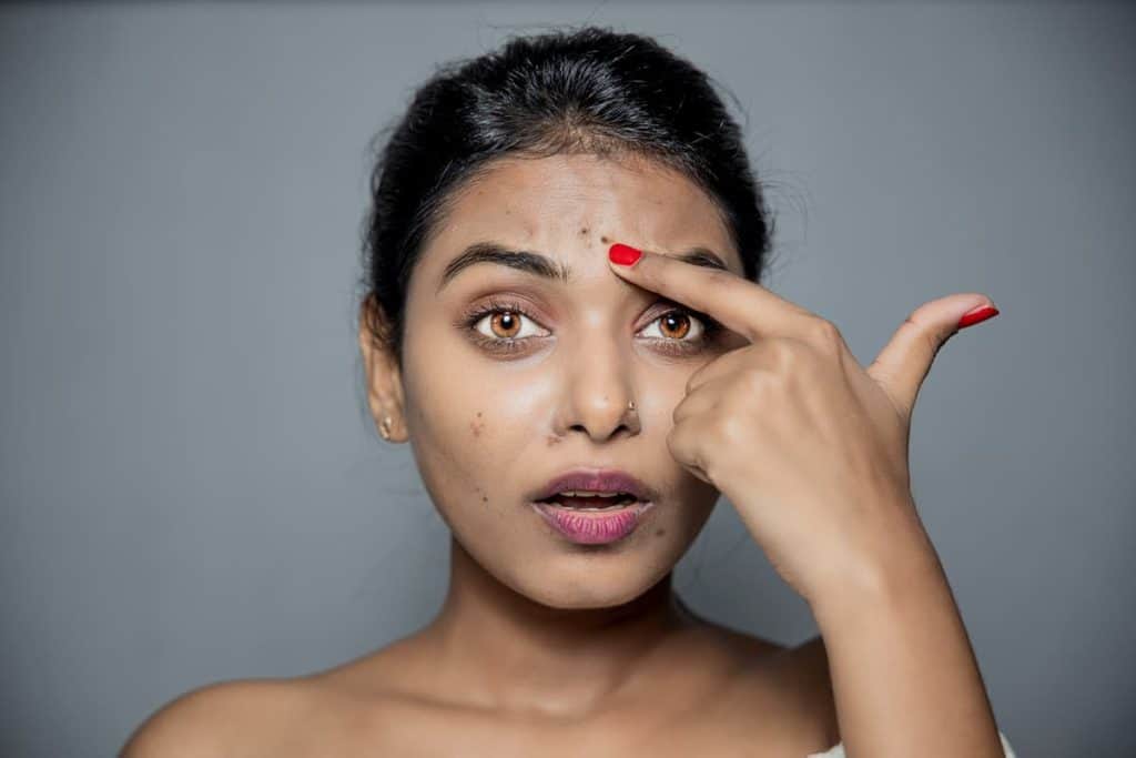 A woman is pointing her finger at her face, possibly discussing the benefits of using hydroquinone over the counter.