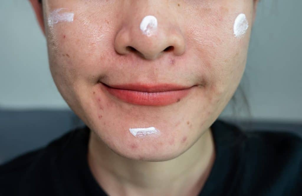 Cropped shot view of Asian woman smiling after she applying acne cream on her face for solving acne problem. 